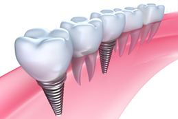 Implantes Dentários